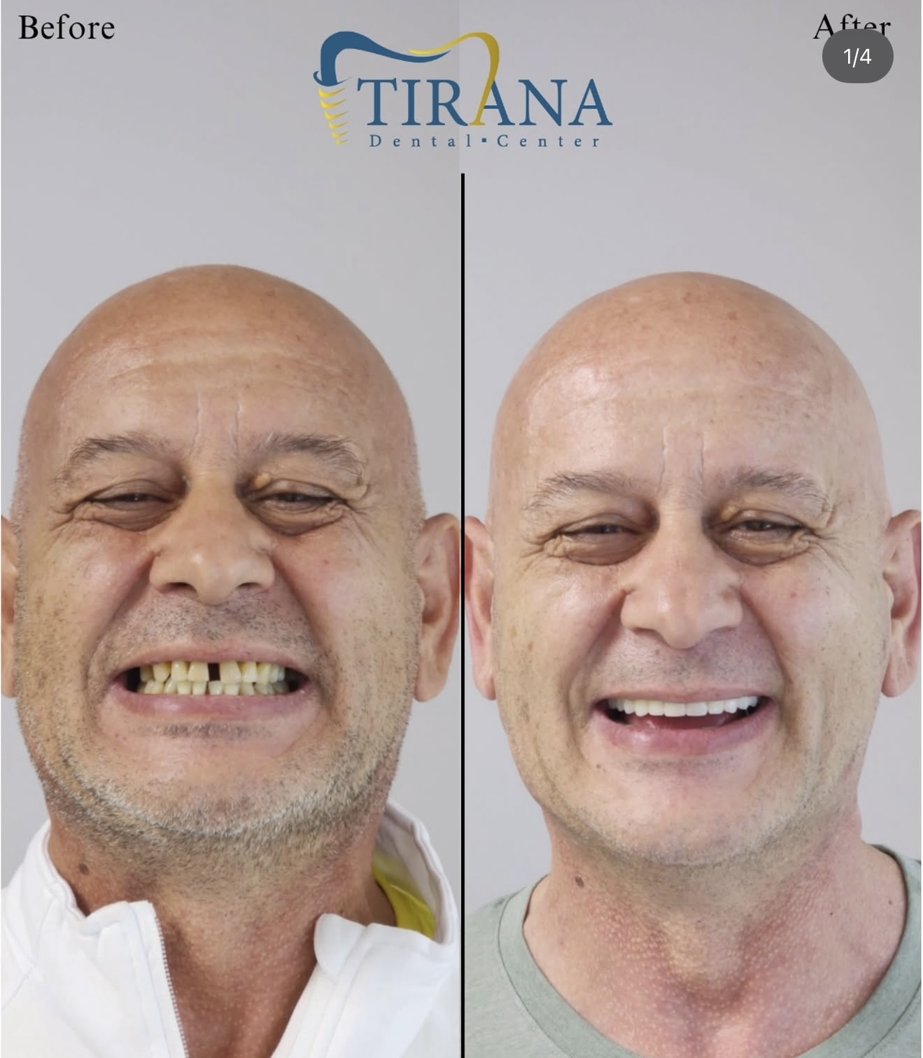 Before and after: Full Mouth Implants + Crowns
