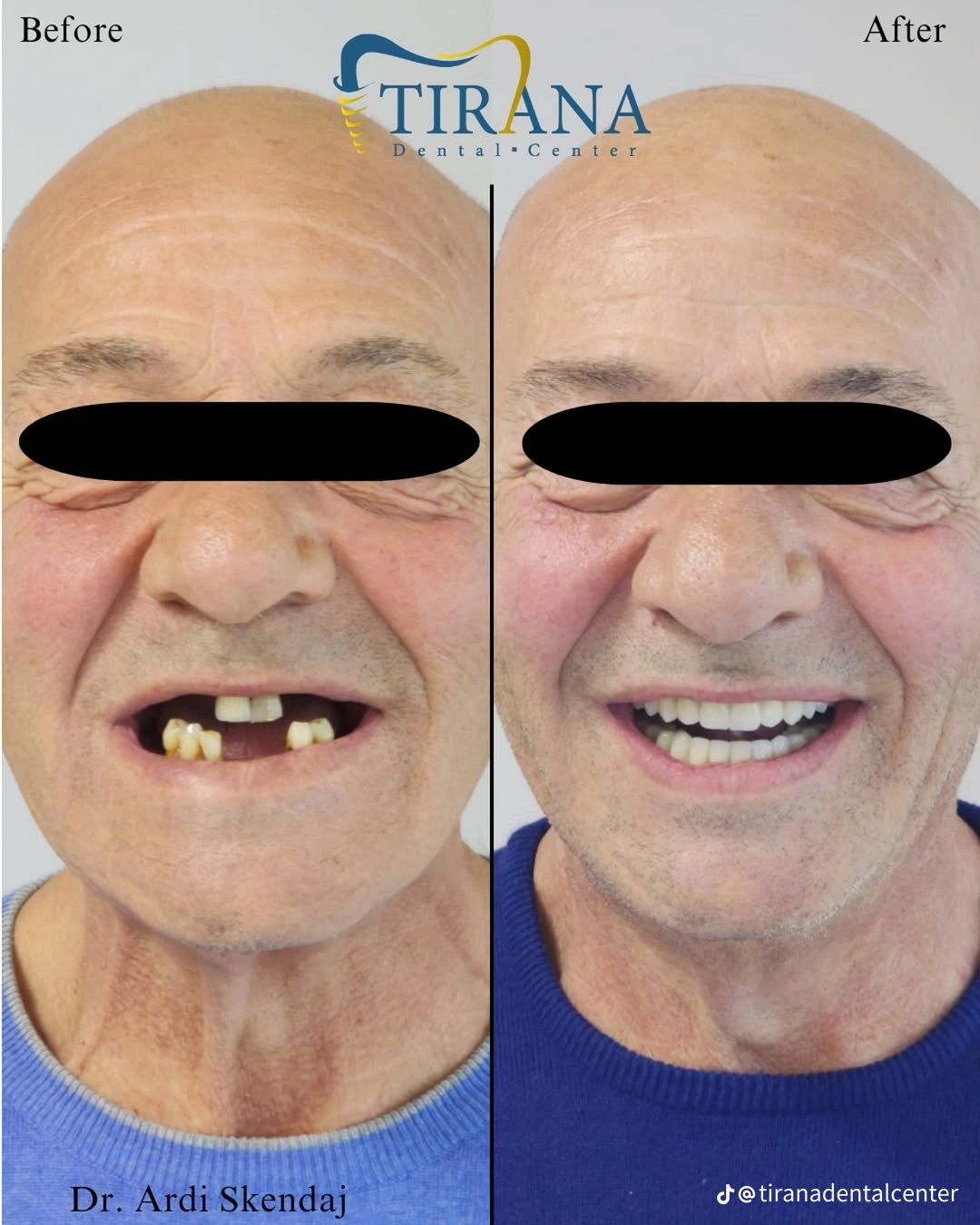 Before and after: All-on-4 Both Arches