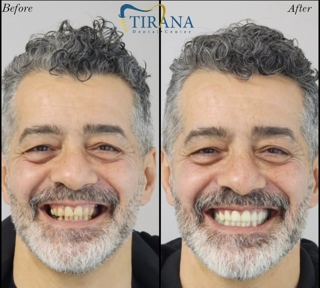 Before and after: All-on-6 Upper Implants