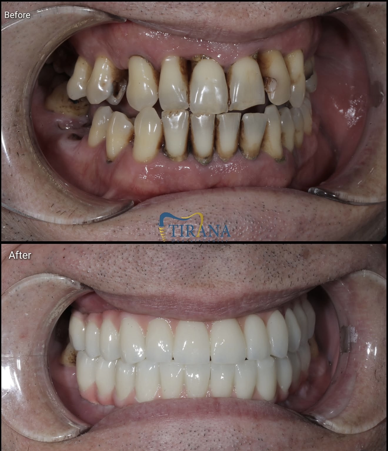 Before and after: Full Smile Reconstruction