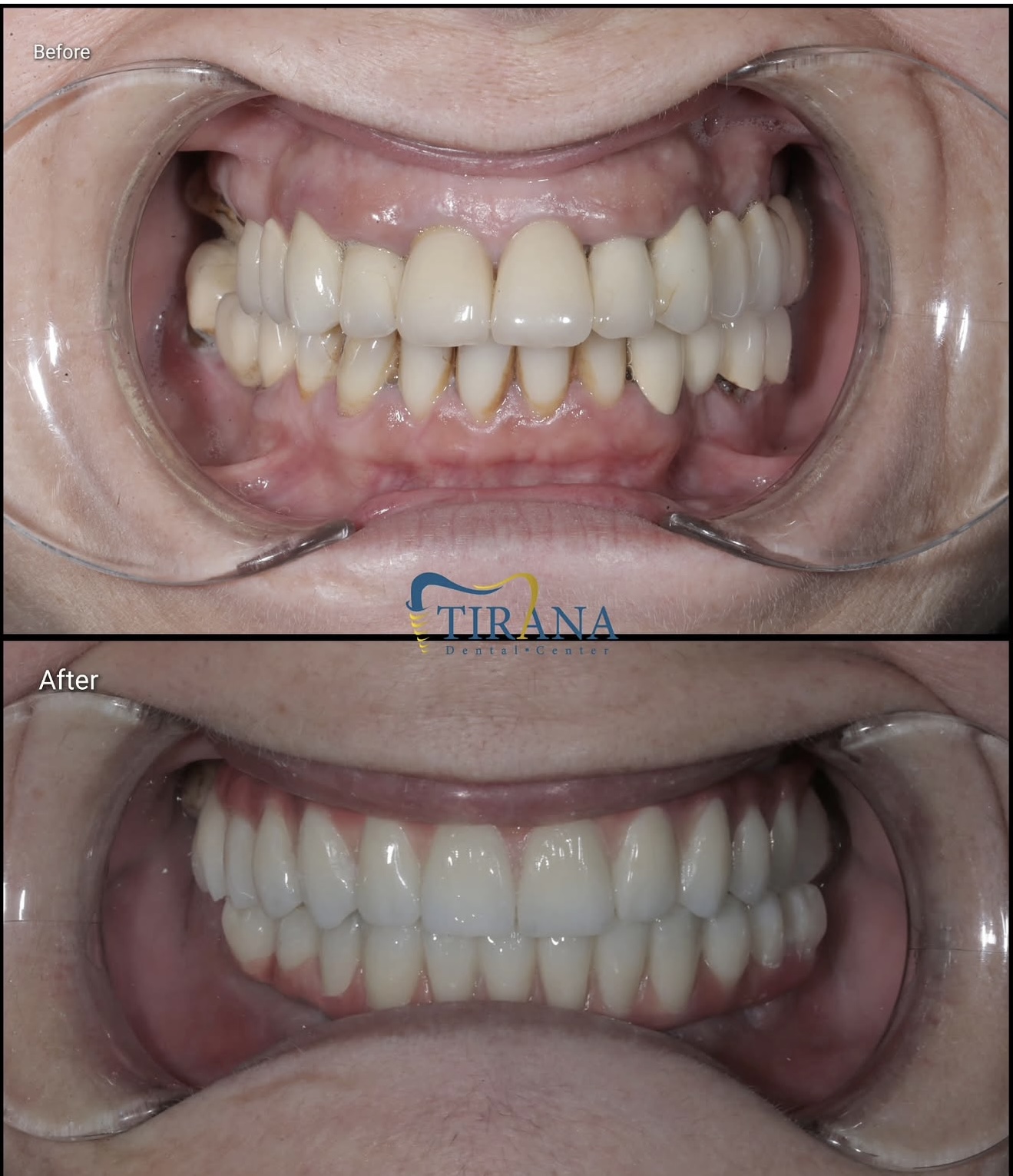 Before and after: Upper & Lower Veneers