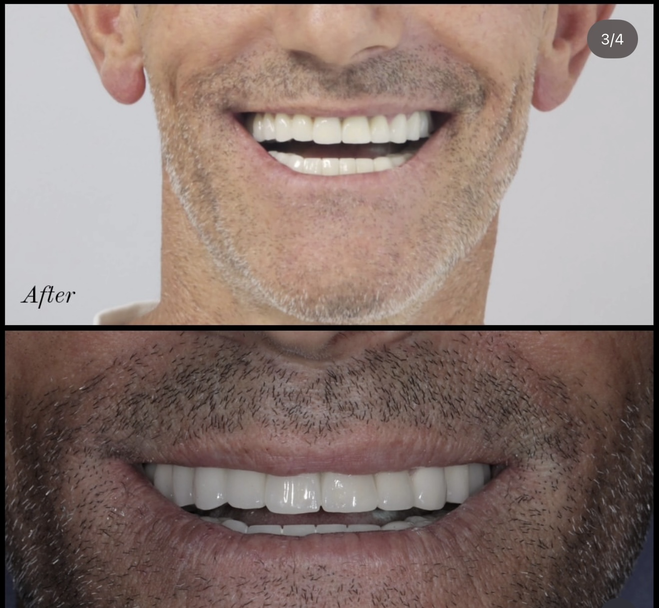 After 20 Zirconia Crowns