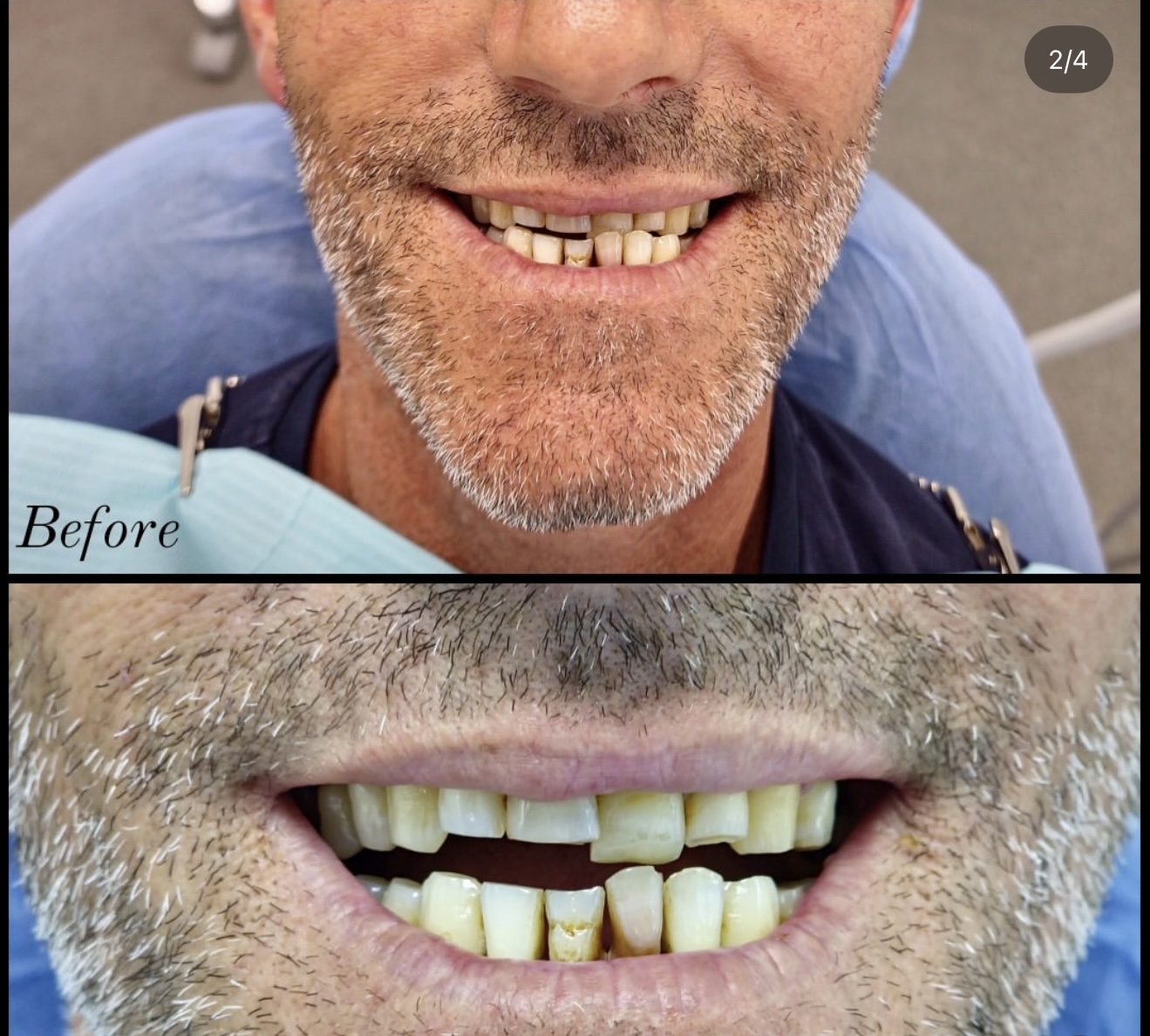 Before 20 Zirconia Crowns