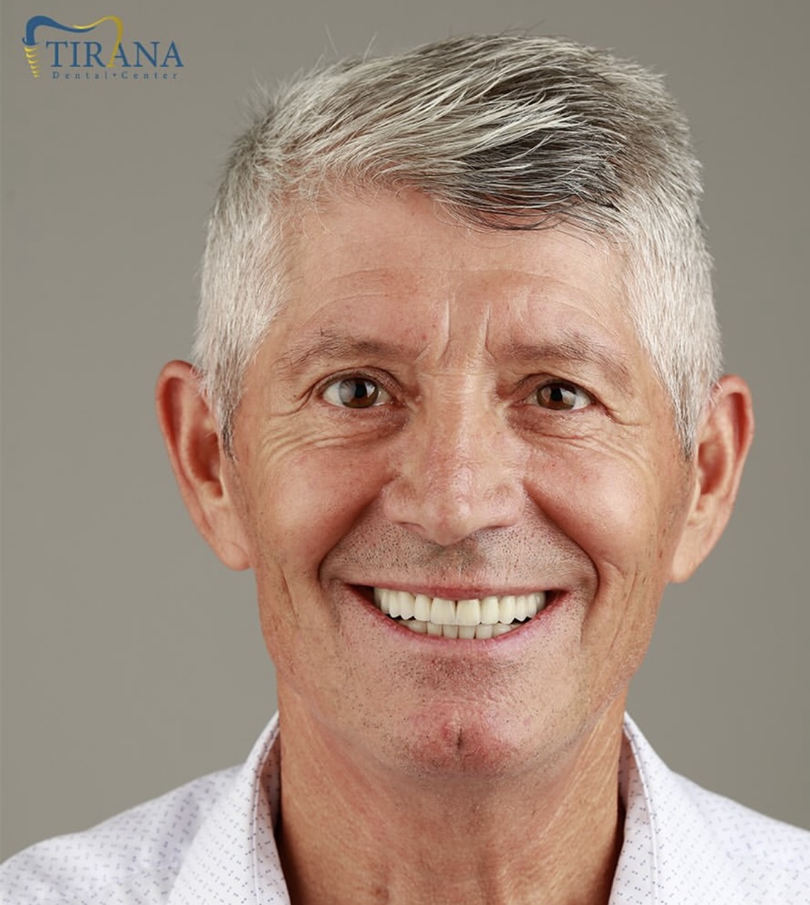 After 10 Emax Veneers