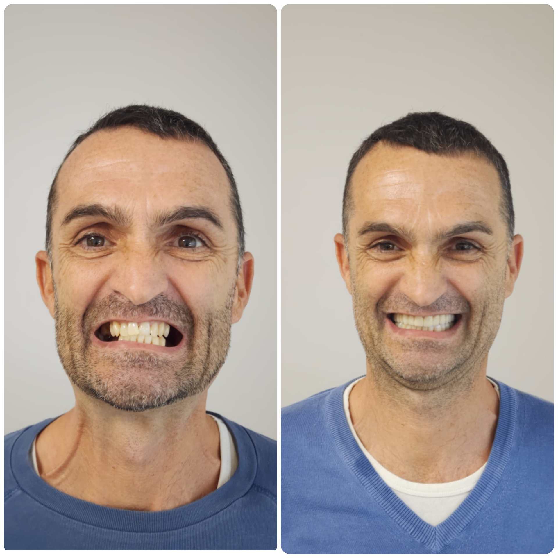 Before and after: Implants + Zirconia Crowns