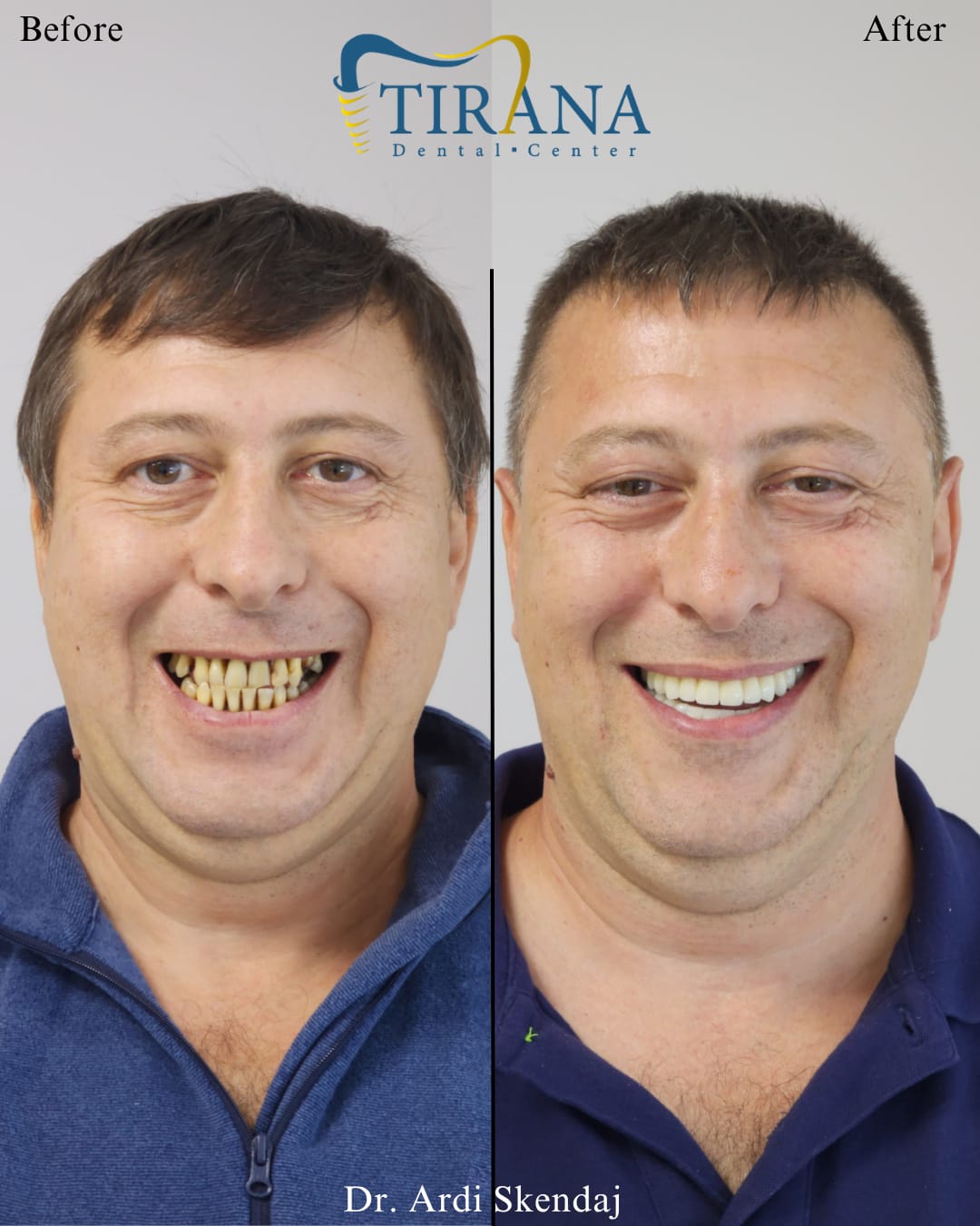 Before and after: Full Upper & Lower Restoration